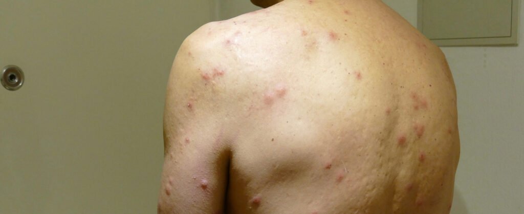 bedbug pest control sydney